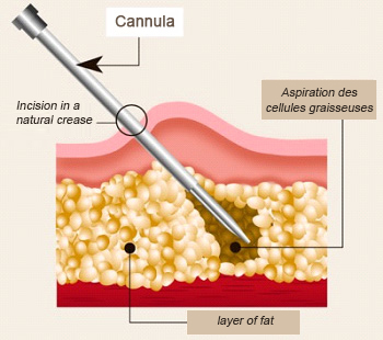 liposuction tunisia